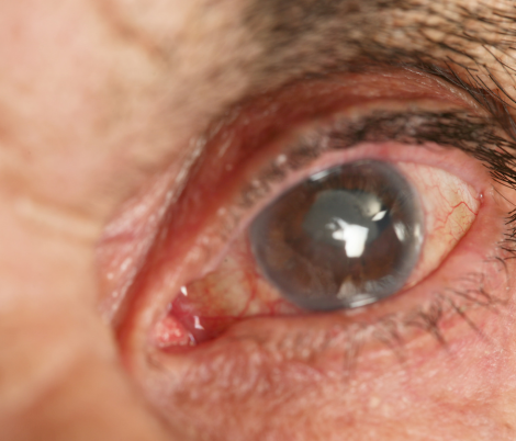 pterygium