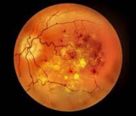 diabetic-retinopathy